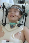 A patient with a halo brace and tracheostomy